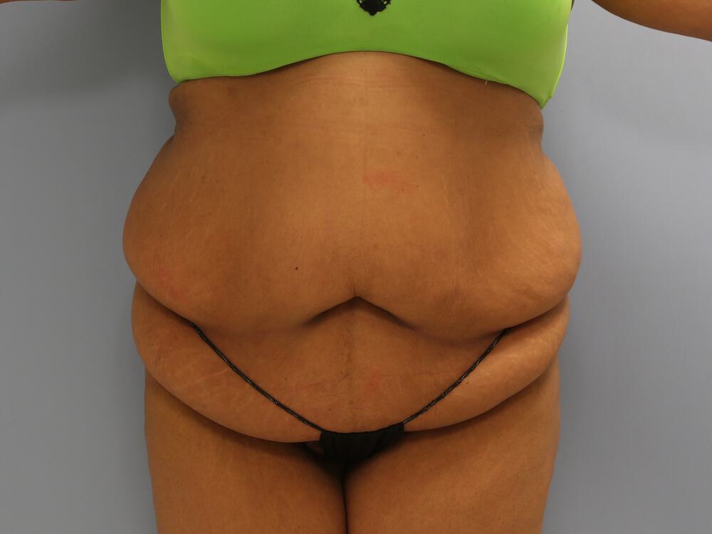 Surgery after weight loss Before & After Image