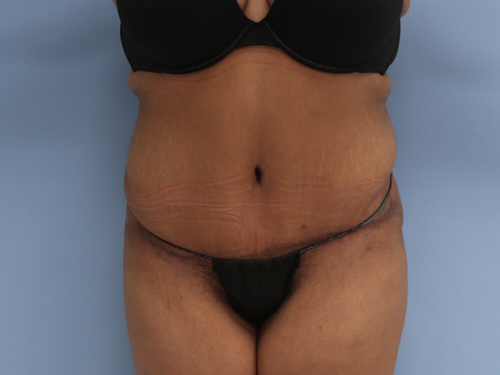 Surgery after weight loss Before & After Image