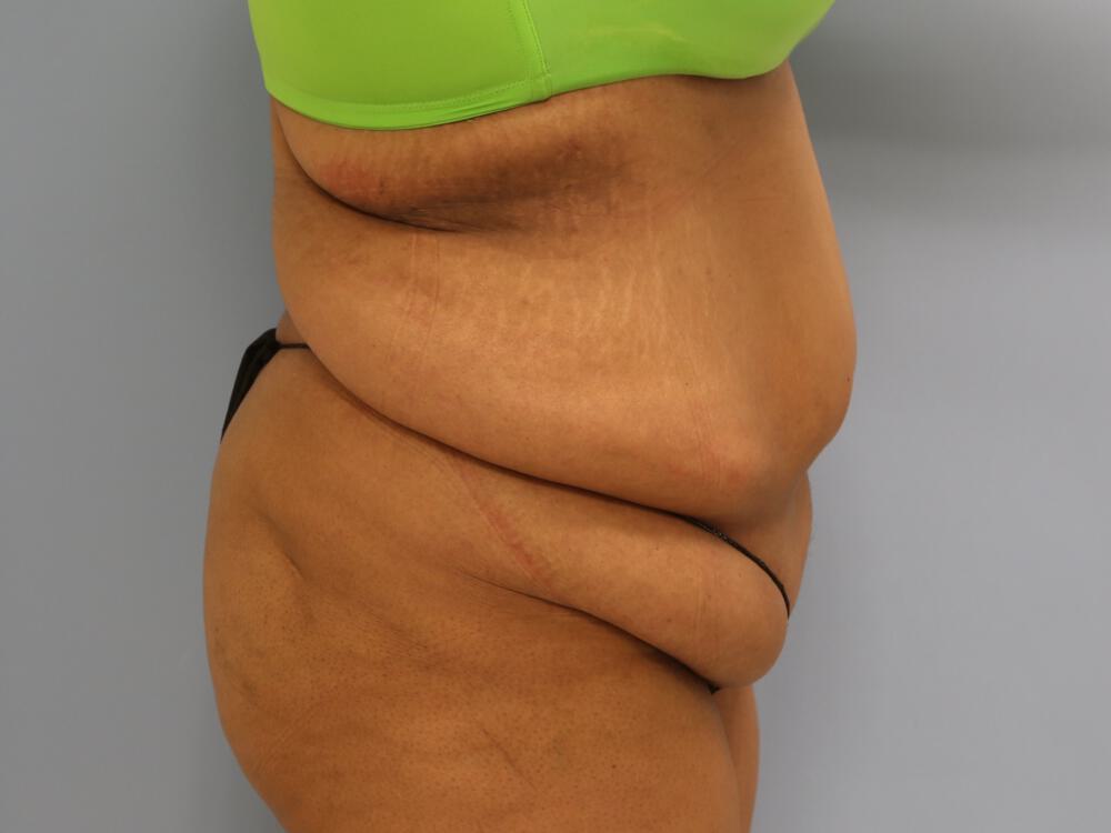 Surgery after weight loss Before & After Image