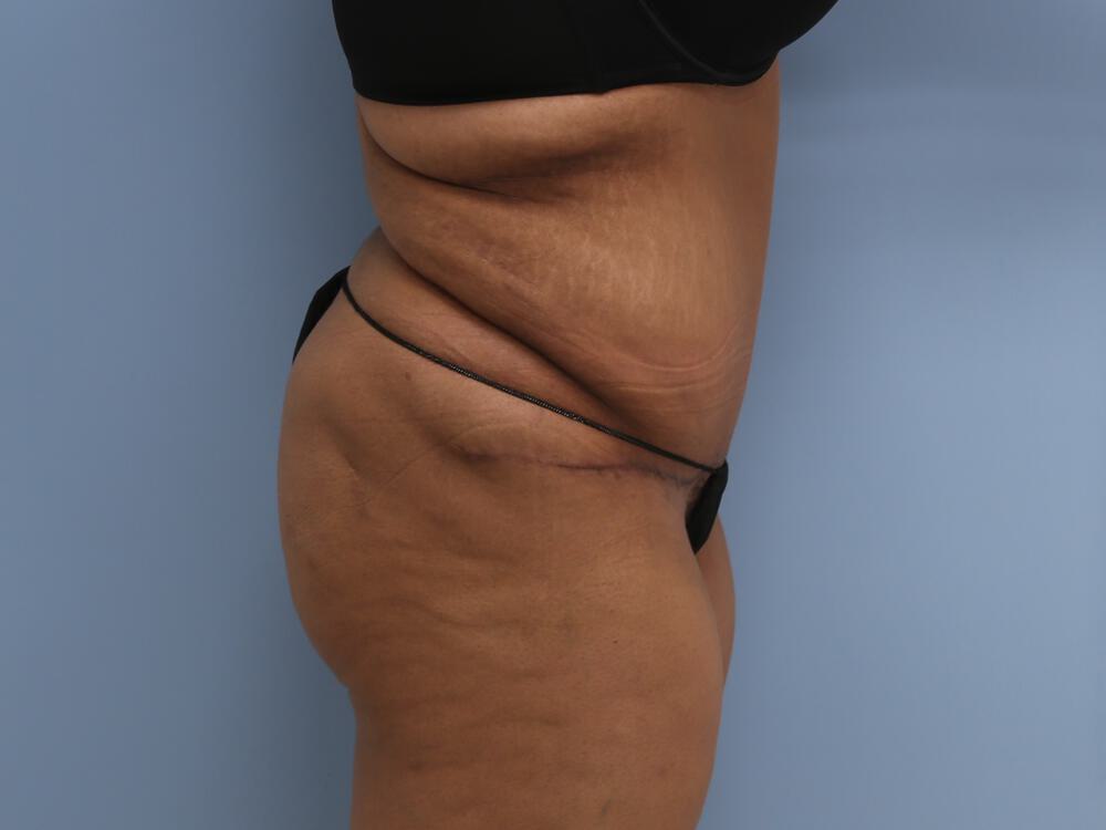 Surgery after weight loss Before & After Image