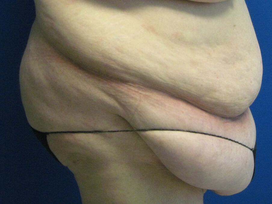 Surgery after weight loss Before & After Image