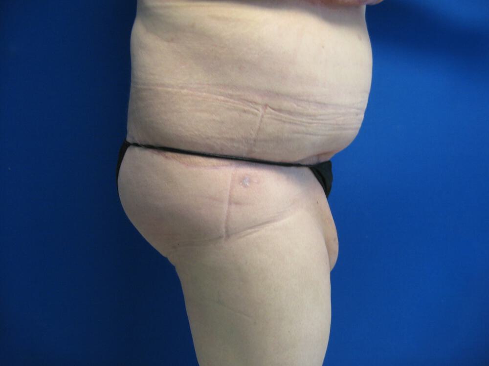 Surgery after weight loss Before & After Image