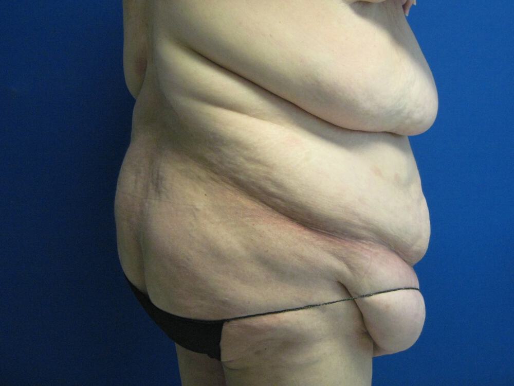 Surgery after weight loss Before & After Image