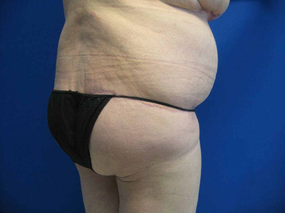 Surgery after weight loss Before & After Image