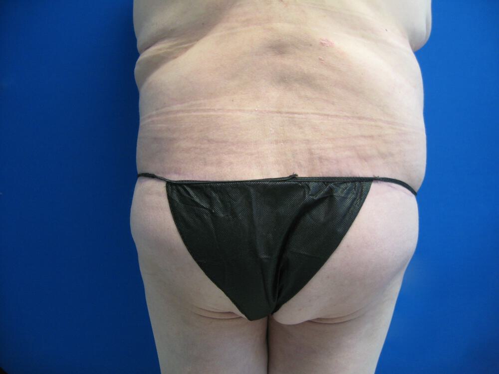 Surgery After Weight Loss Before & After Image