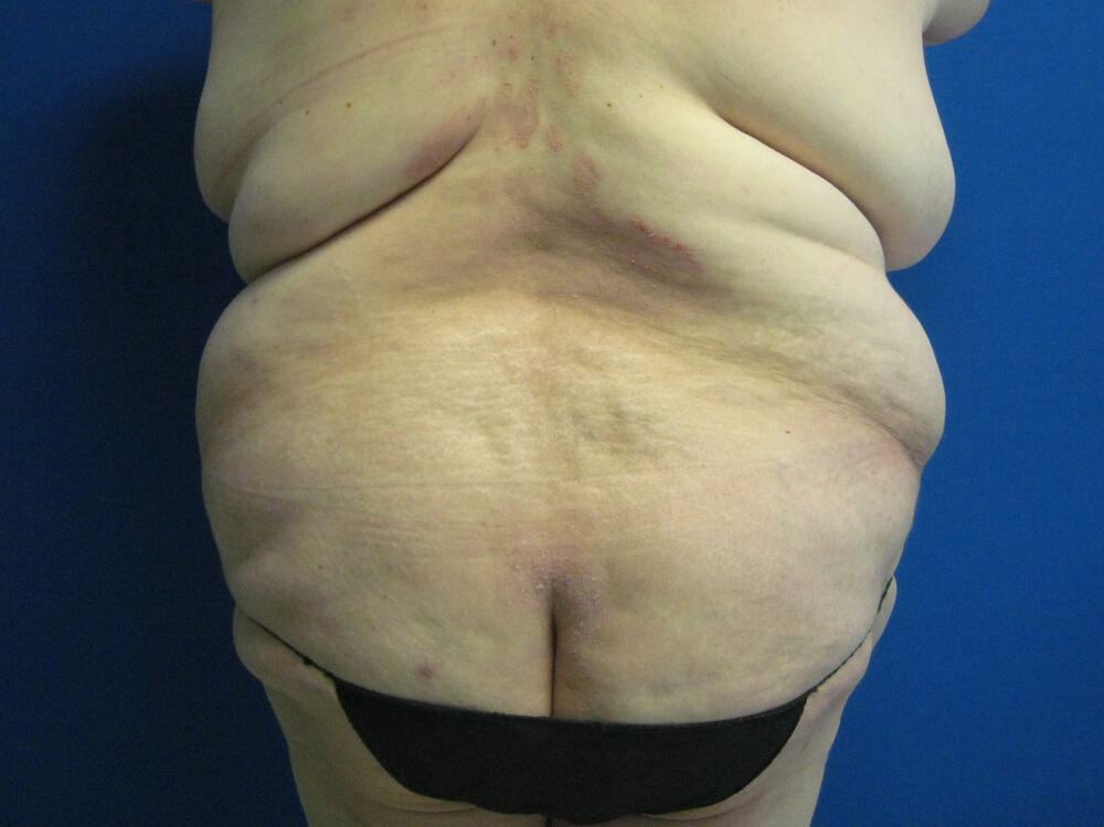 Surgery After Weight Loss Before & After Image