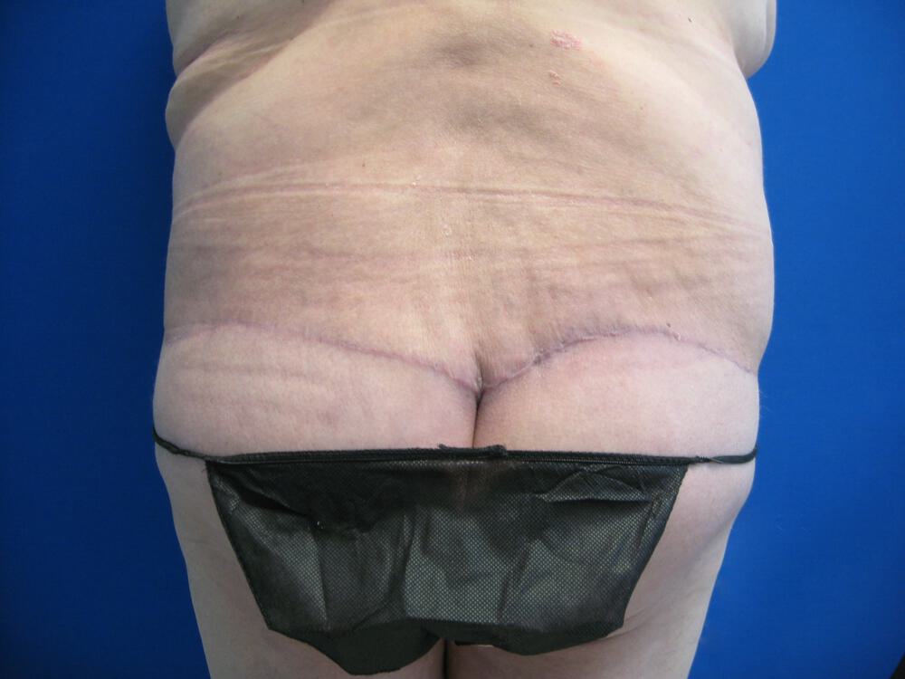 Surgery After Weight Loss Before & After Image
