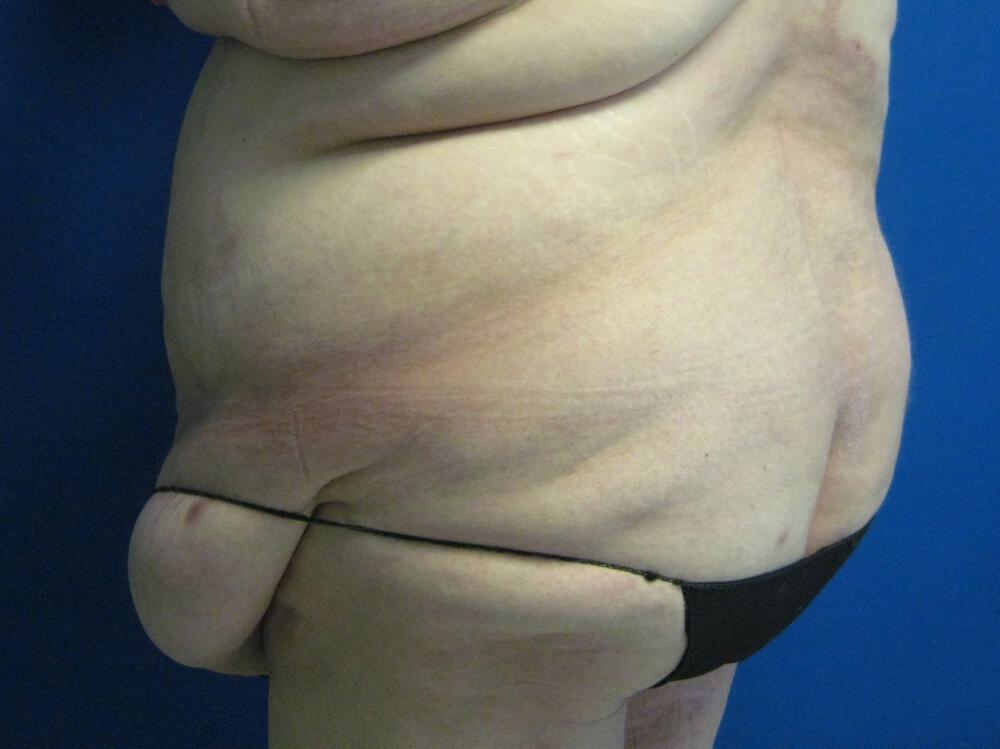 Surgery After Weight Loss Before & After Image