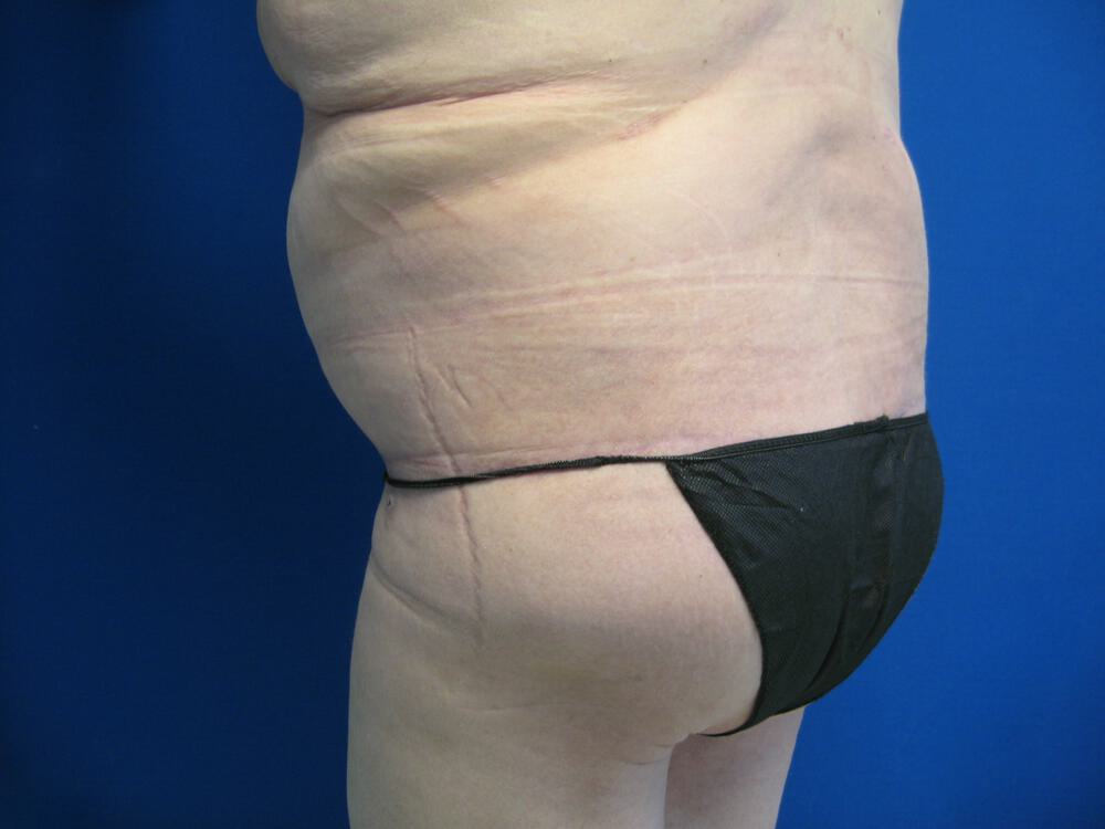 Surgery After Weight Loss Before & After Image