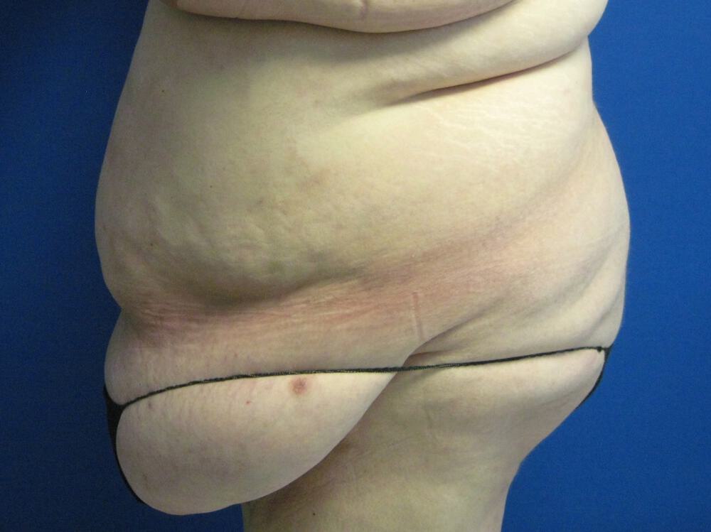 Surgery After Weight Loss Before & After Image