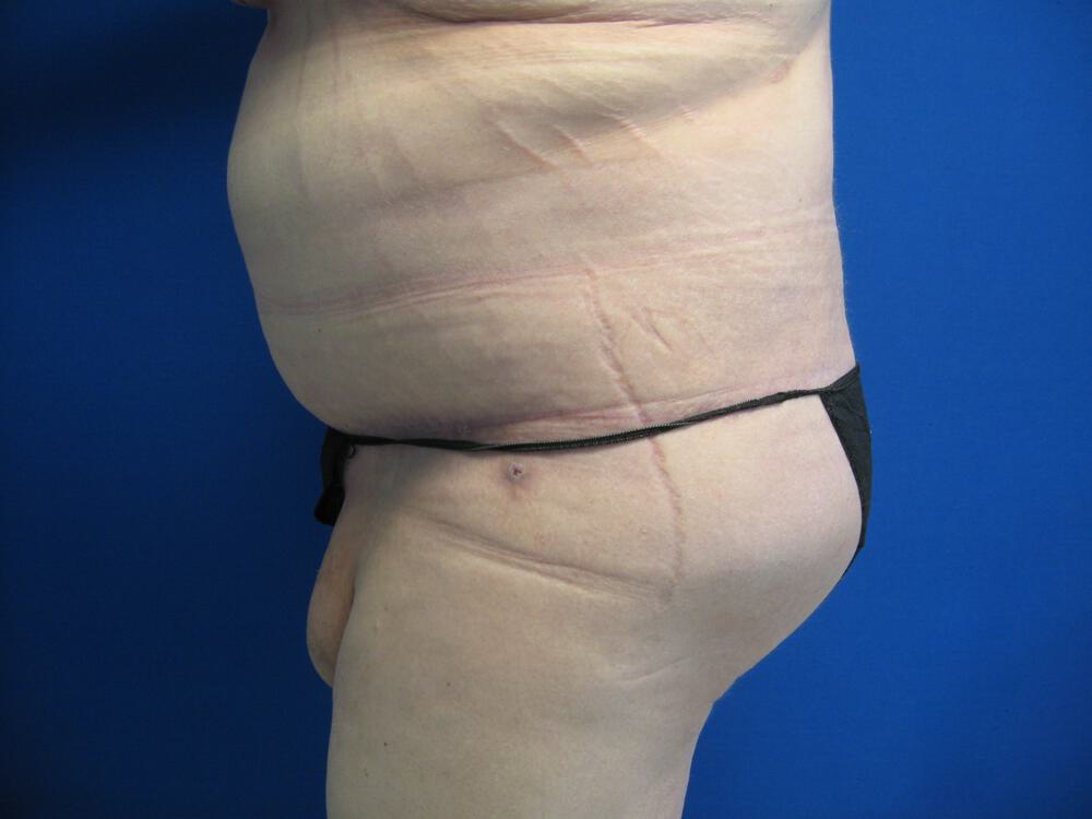 Surgery After Weight Loss Before & After Image