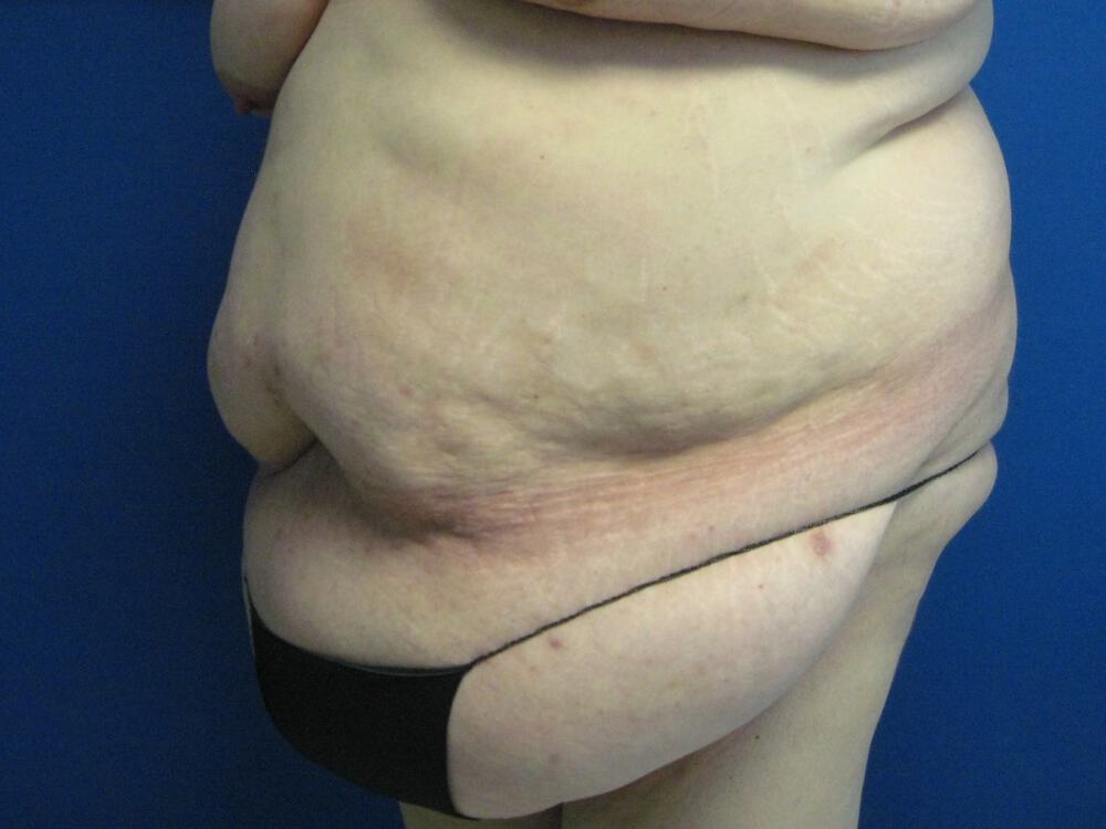 Surgery After Weight Loss Before & After Image