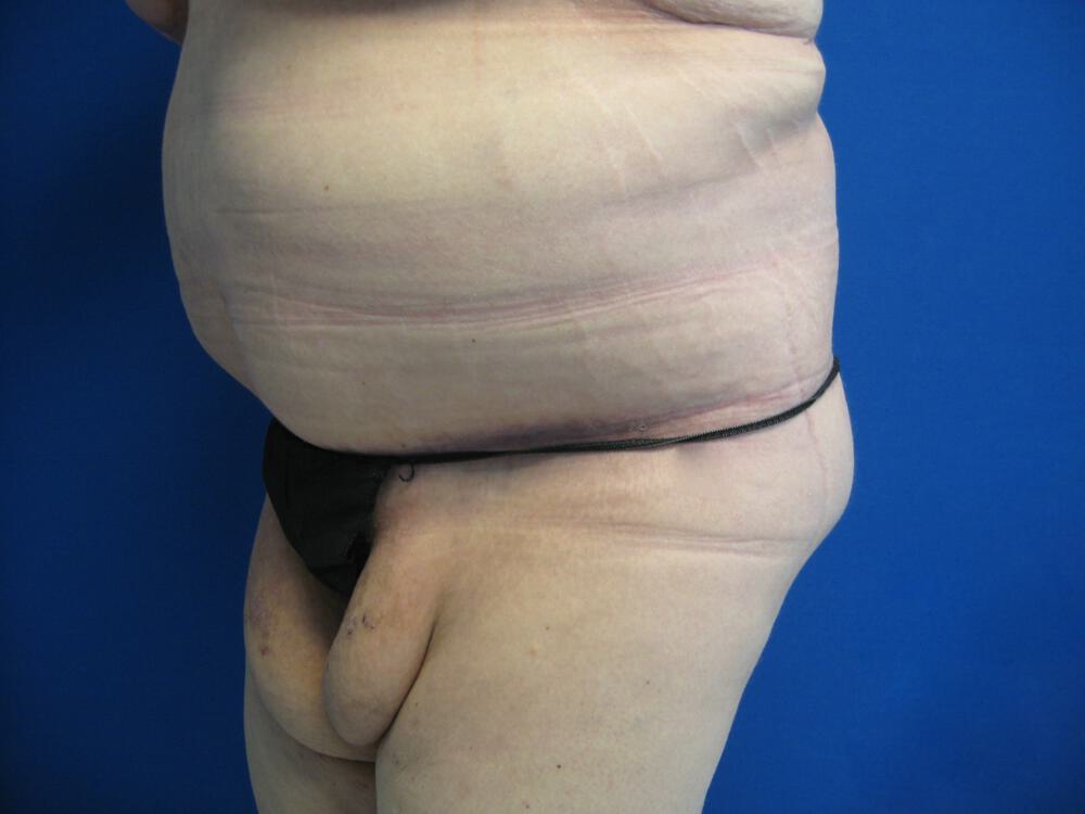 Surgery After Weight Loss Before & After Image