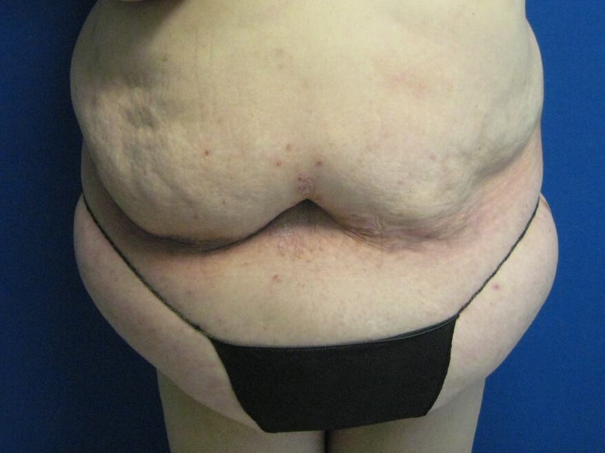Surgery After Weight Loss Before & After Image