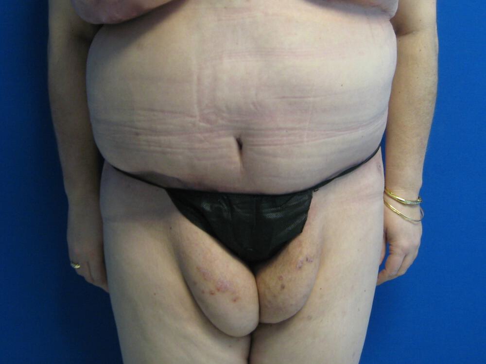 Surgery After Weight Loss Before & After Image