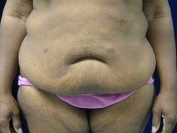 Surgery after weight loss Before & After Image