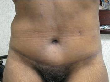 Surgery after weight loss Before & After Image