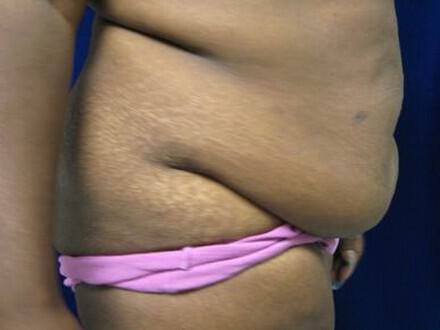 Surgery after weight loss Before & After Image