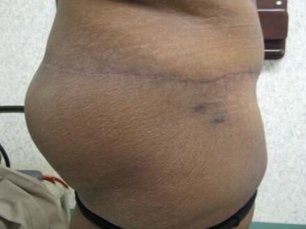 Surgery after weight loss Before & After Image