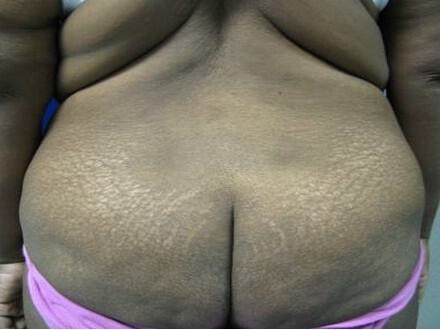 Surgery After Weight Loss Before & After Image