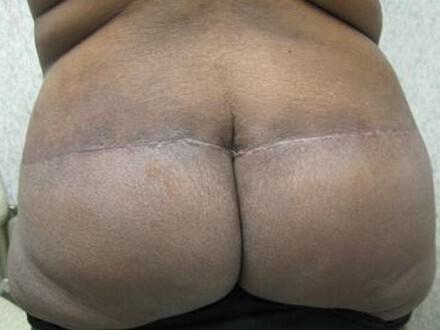 Surgery After Weight Loss Before & After Image