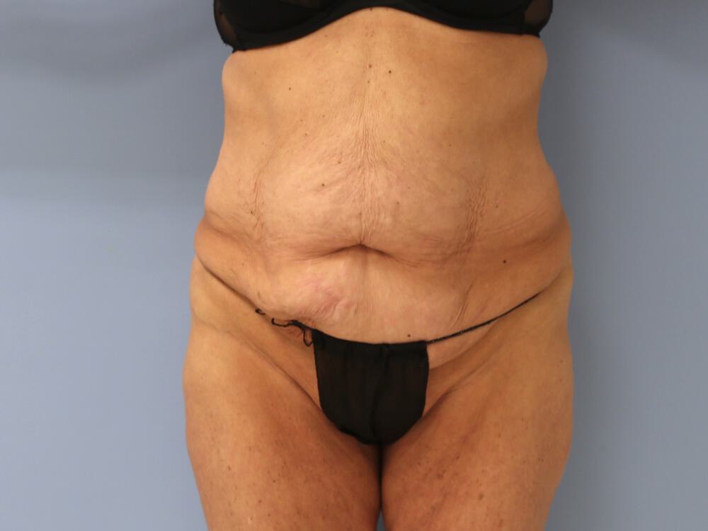 Surgery after weight loss Before & After Image