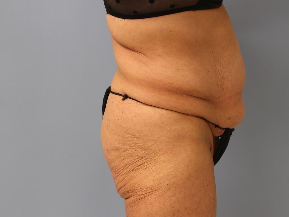 Surgery after weight loss Before & After Image