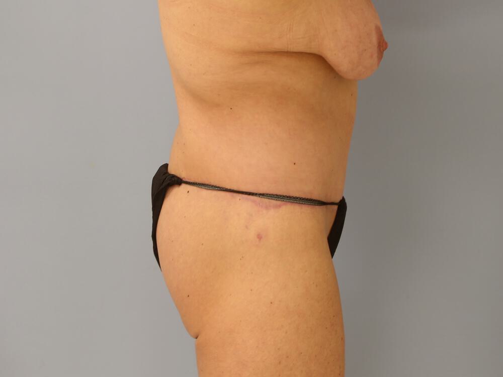 Surgery after weight loss Before & After Image