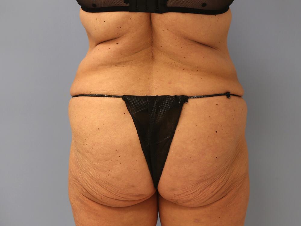 Surgery After Weight Loss Before & After Image