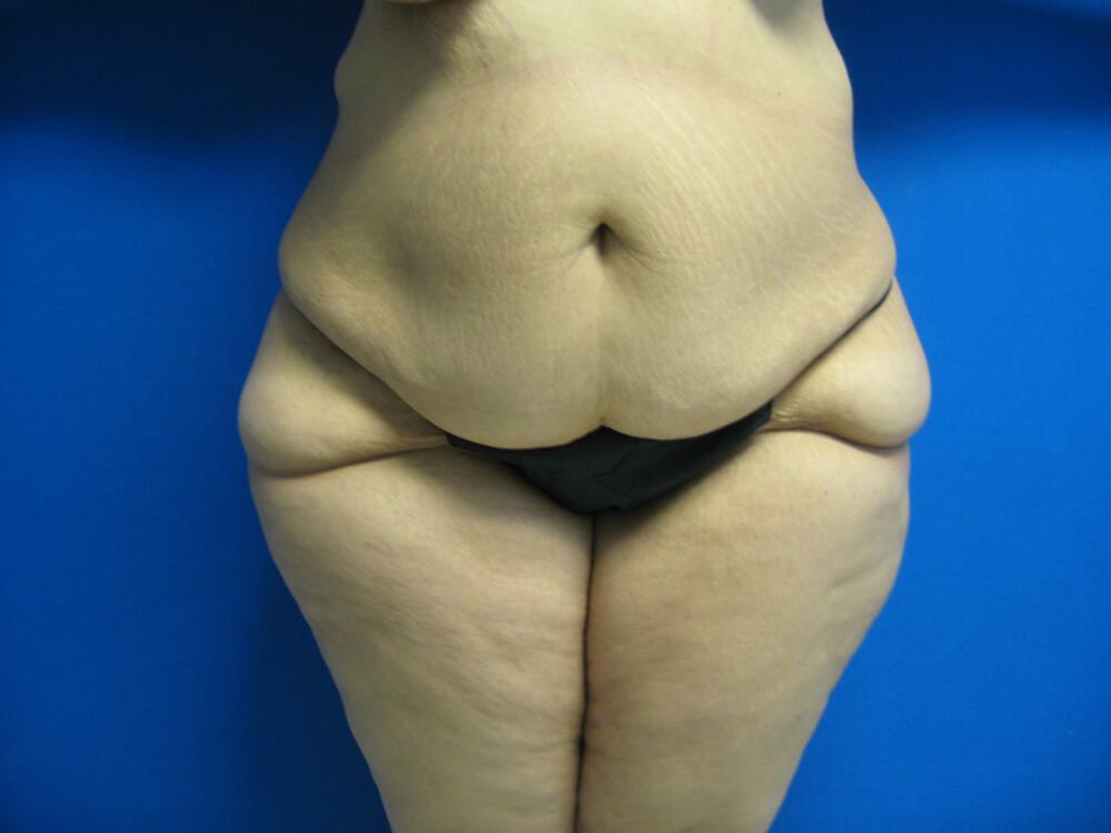 Surgery after weight loss Before & After Image