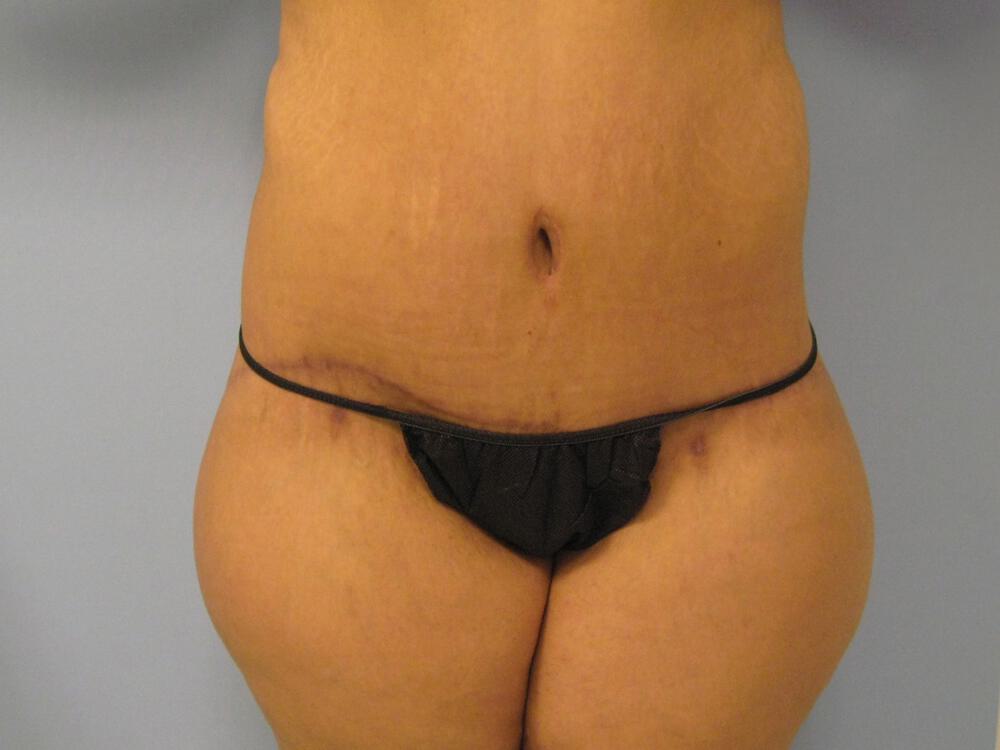 Surgery after weight loss Before & After Image