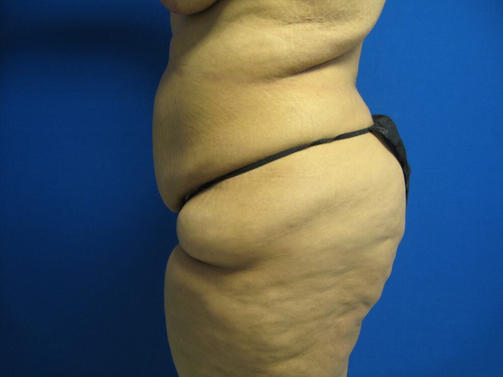 Surgery after weight loss Before & After Image