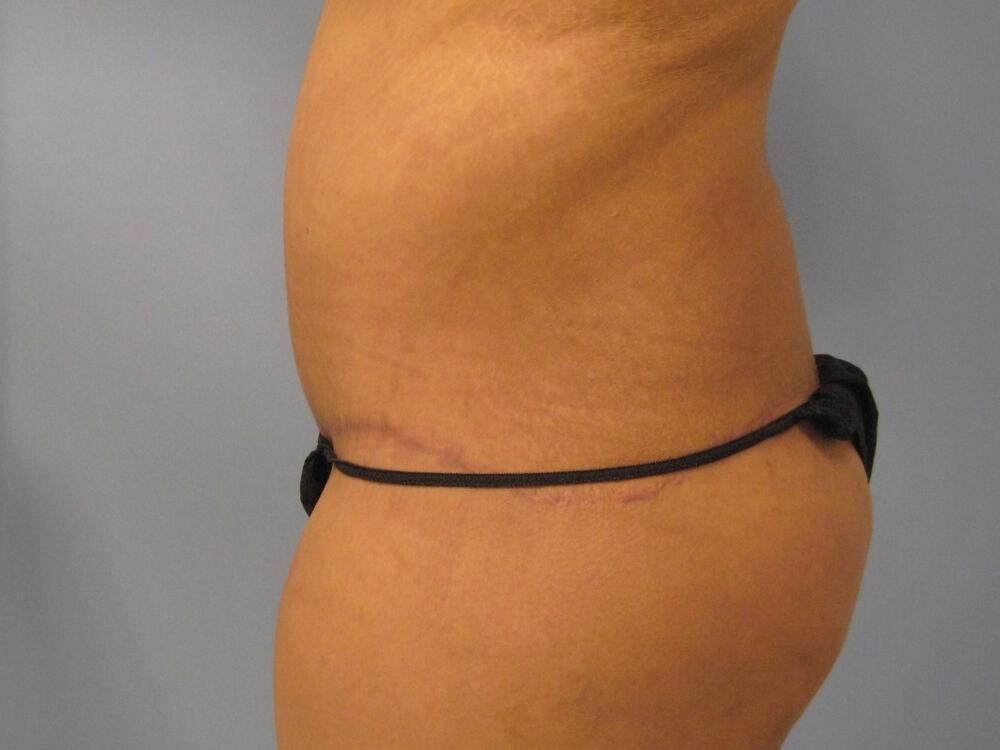 Surgery after weight loss Before & After Image