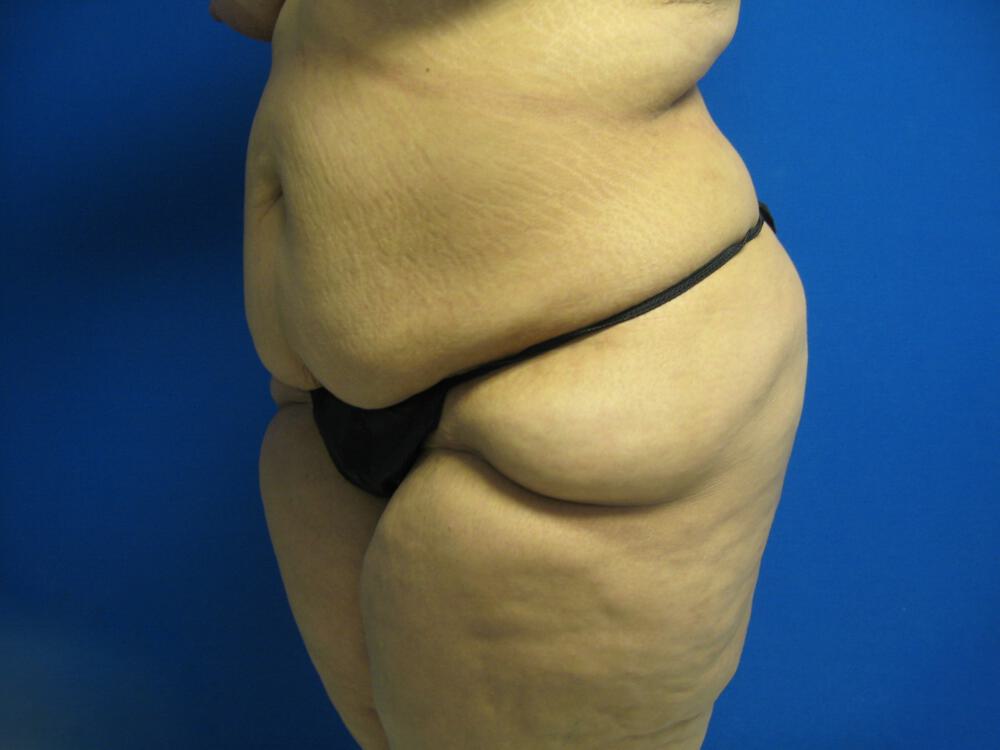 Surgery After Weight Loss Before & After Image