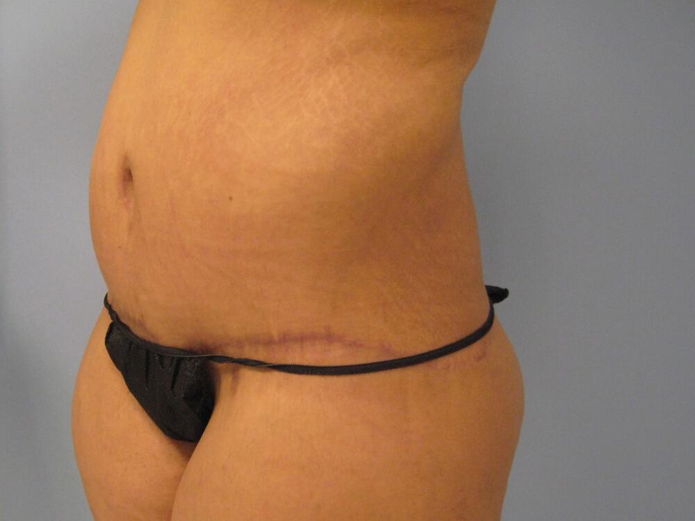 Surgery After Weight Loss Before & After Image