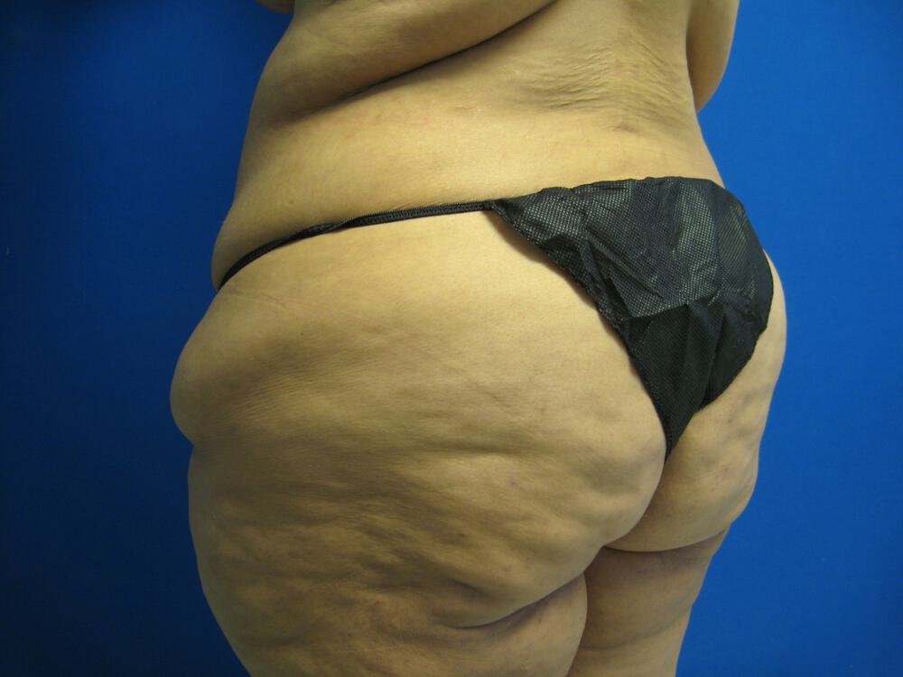 Surgery After Weight Loss Before & After Image