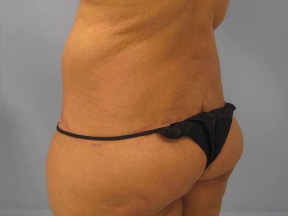 Surgery After Weight Loss Before & After Image