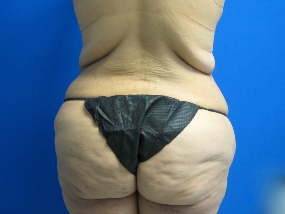 Surgery After Weight Loss Before & After Image