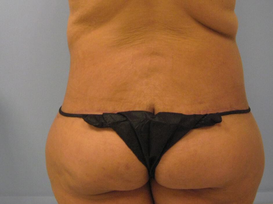 Surgery After Weight Loss Before & After Image