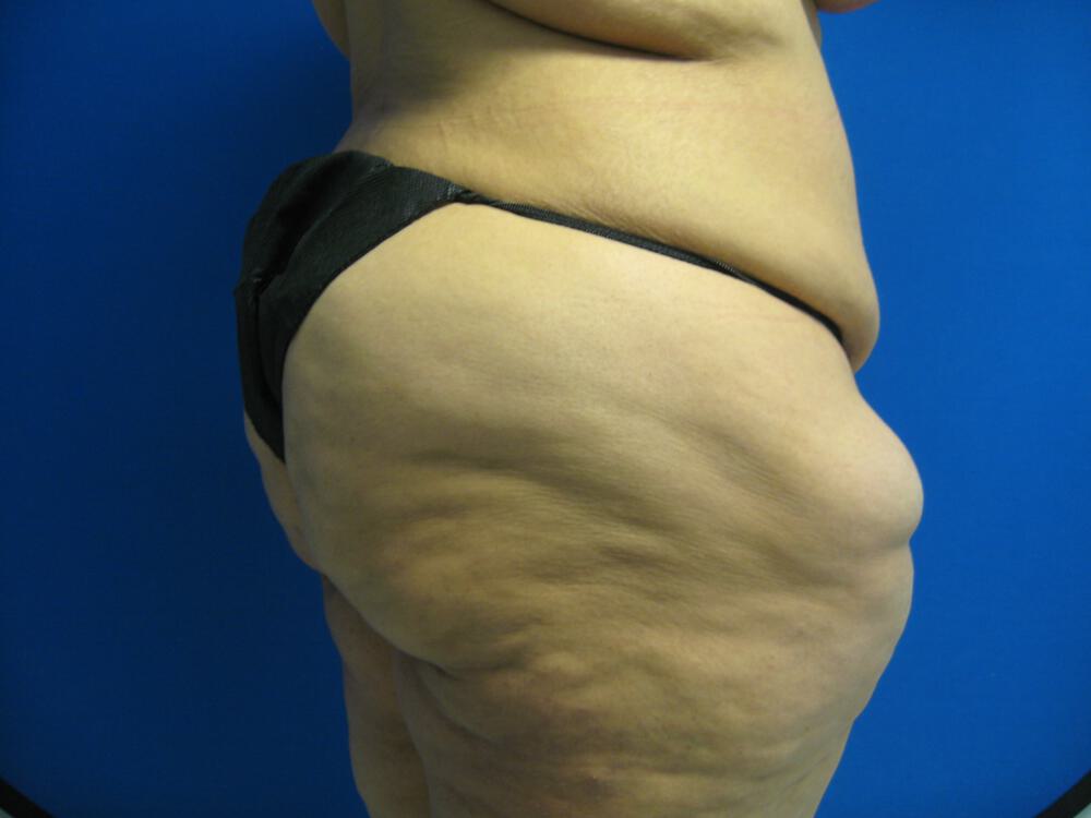 Surgery After Weight Loss Before & After Image