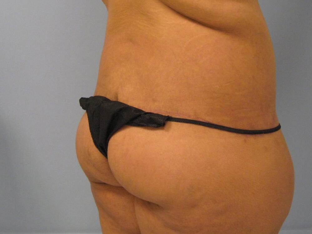 Surgery After Weight Loss Before & After Image