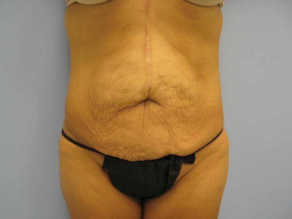 Surgery after weight loss Before & After Image