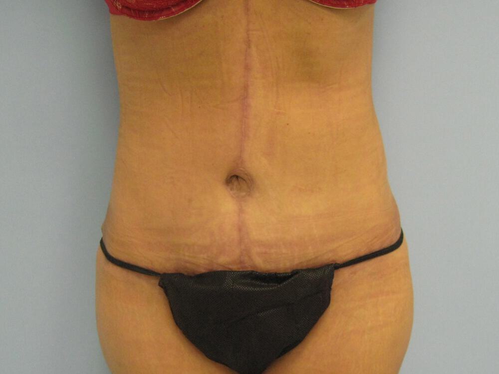 Surgery after weight loss Before & After Image