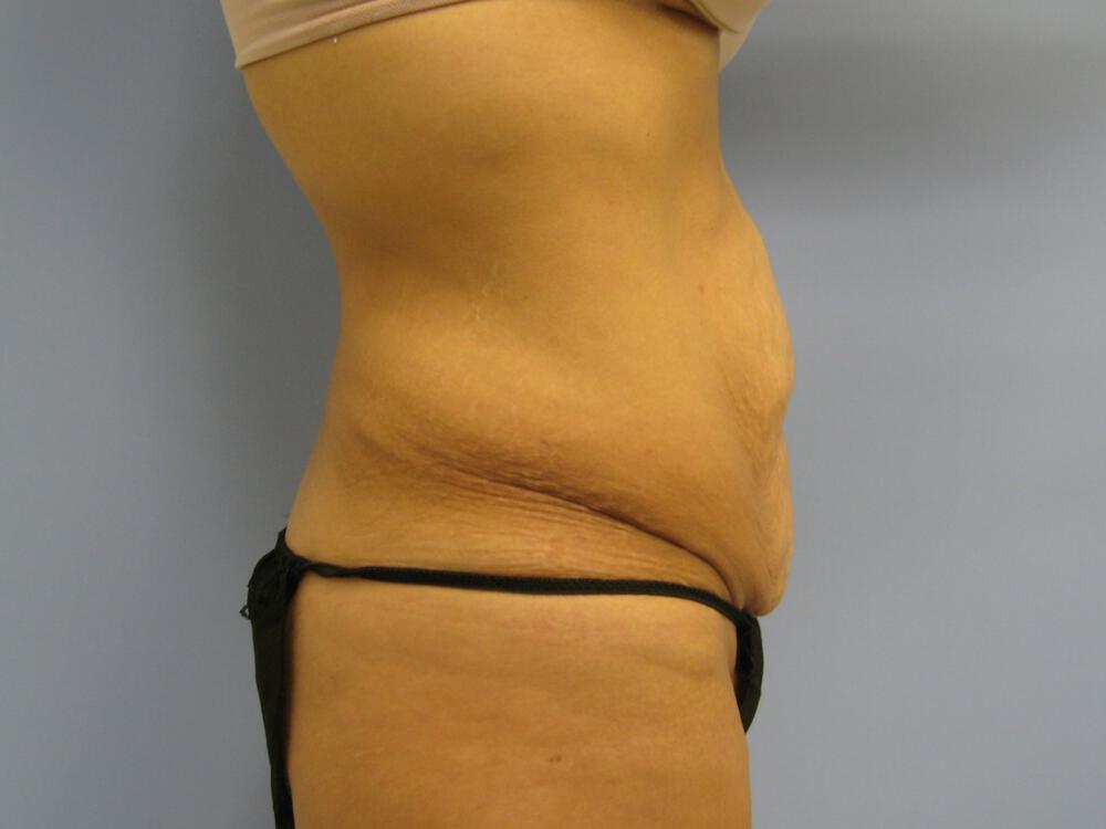 Surgery after weight loss Before & After Image