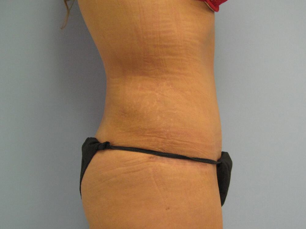 Surgery after weight loss Before & After Image