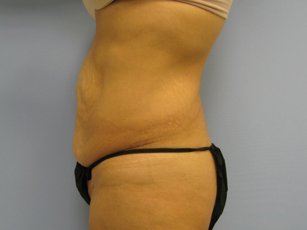 Surgery After Weight Loss Before & After Image