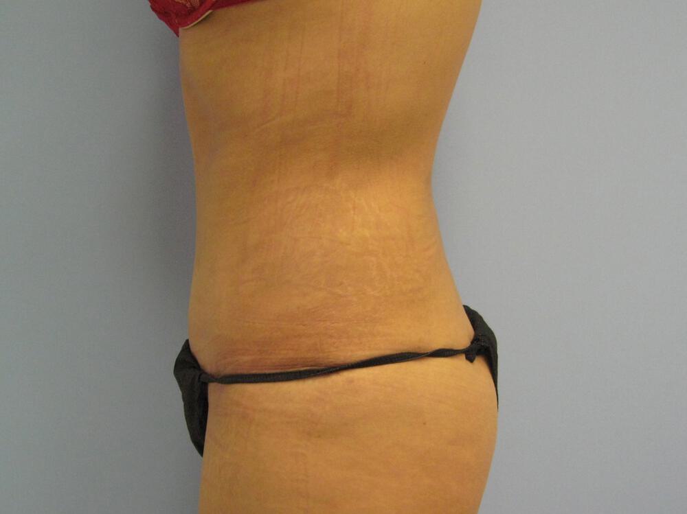 Surgery After Weight Loss Before & After Image