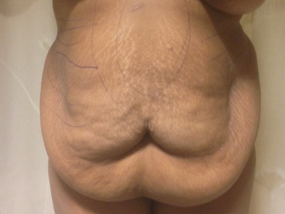 Surgery after weight loss Before & After Image