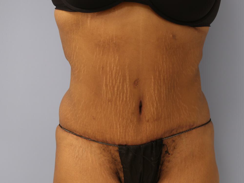 Surgery after weight loss Before & After Image