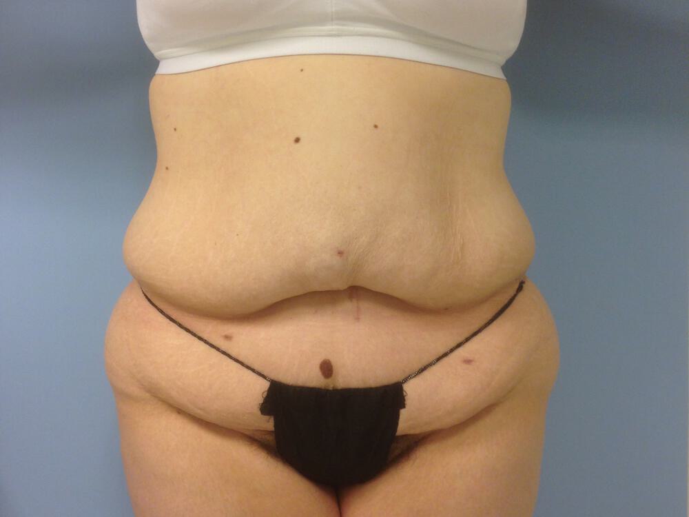 Surgery after weight loss Before & After Image